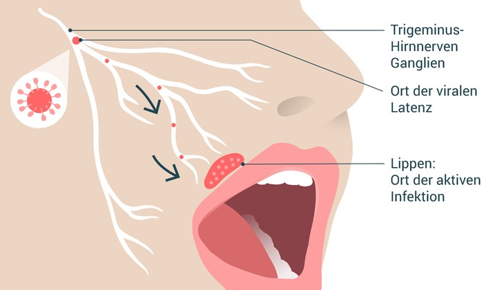 Illustration eines Gesichts: Der Nervenknoten nahe der Schläfe ist als „Trigeminus-Hirnnerven-Ganglien" und „Ort der viralen Latenz" beschriftet; Pfeile führen entlang der Nervenbahnen zur Lippe, dem „Ort der aktiven Infektion".