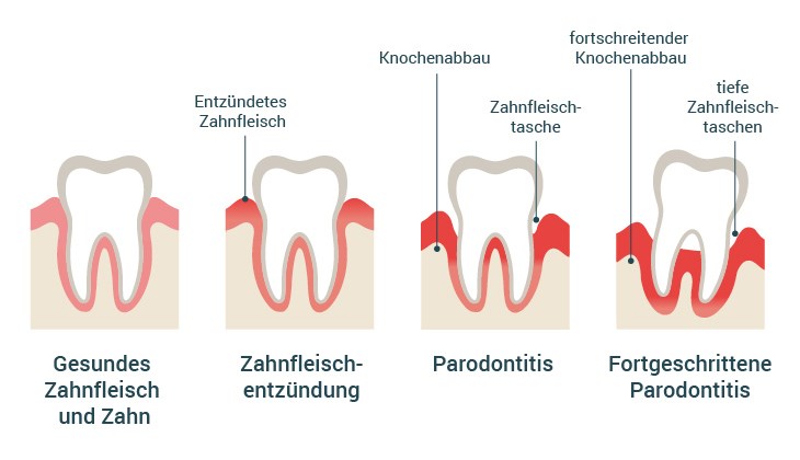 Vier Illustrationen zeigen die Entwicklung vom gesunden Zahn und Zahnfleisch über eine Zahnfleischentzündung zur fortgeschrittenen Parodontitis mit Zahnfleischtasche und Knochenabbau.