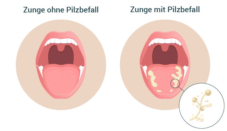 Illustrierter Vergleich zweier geöffneter Münder: links eine gesunde, gleichmäßig rosa Zunge (‚Zunge ohne Pilzbefall'), rechts eine Zunge mit weißlich-gelben Belägen (‚Zunge mit Pilzbefall'), daneben eine vergrößerte Darstellung der Hefepilze.