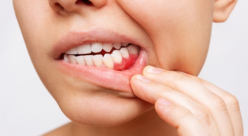 Eine Person hat am Zahnfleisch eine Entzündung